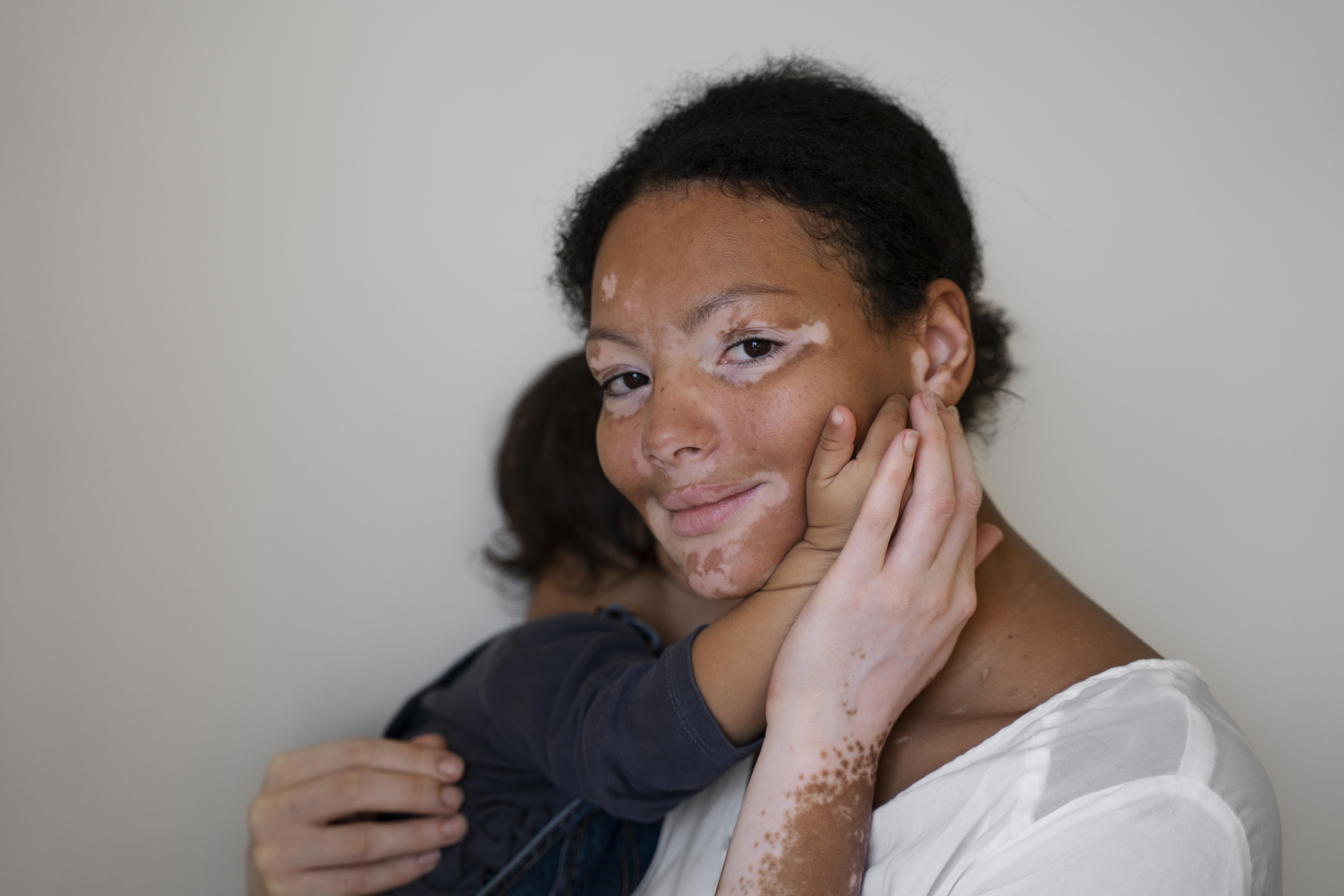 Vitiligo Webinar: Understanding Vitiligo - New Hope for Treatment & Research